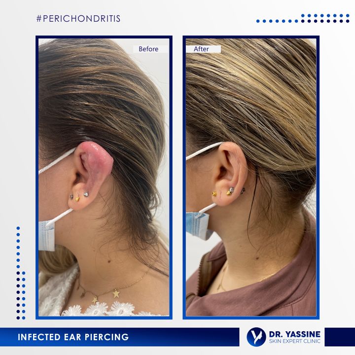 INFECTED EAR PIERCING