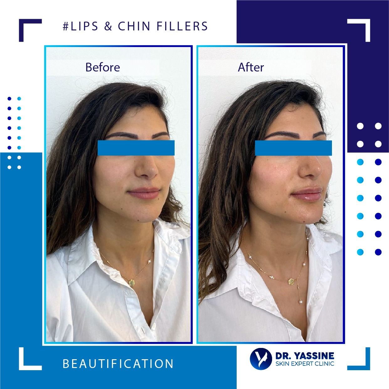Lips & Chin fillers