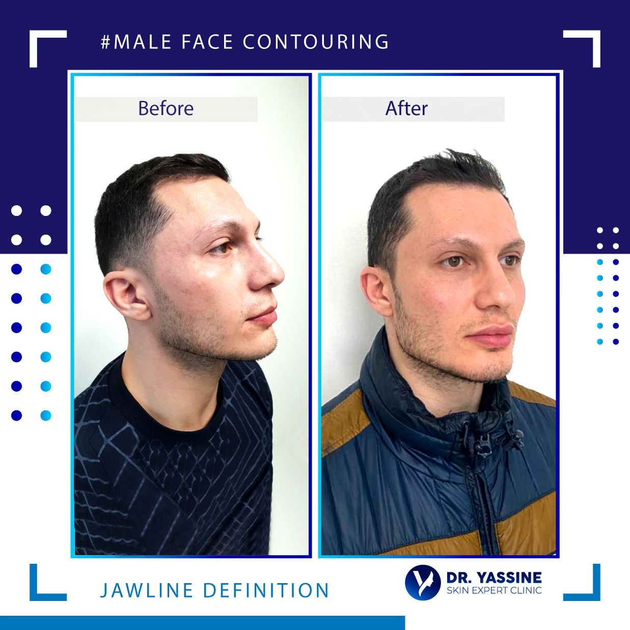Male face contouring