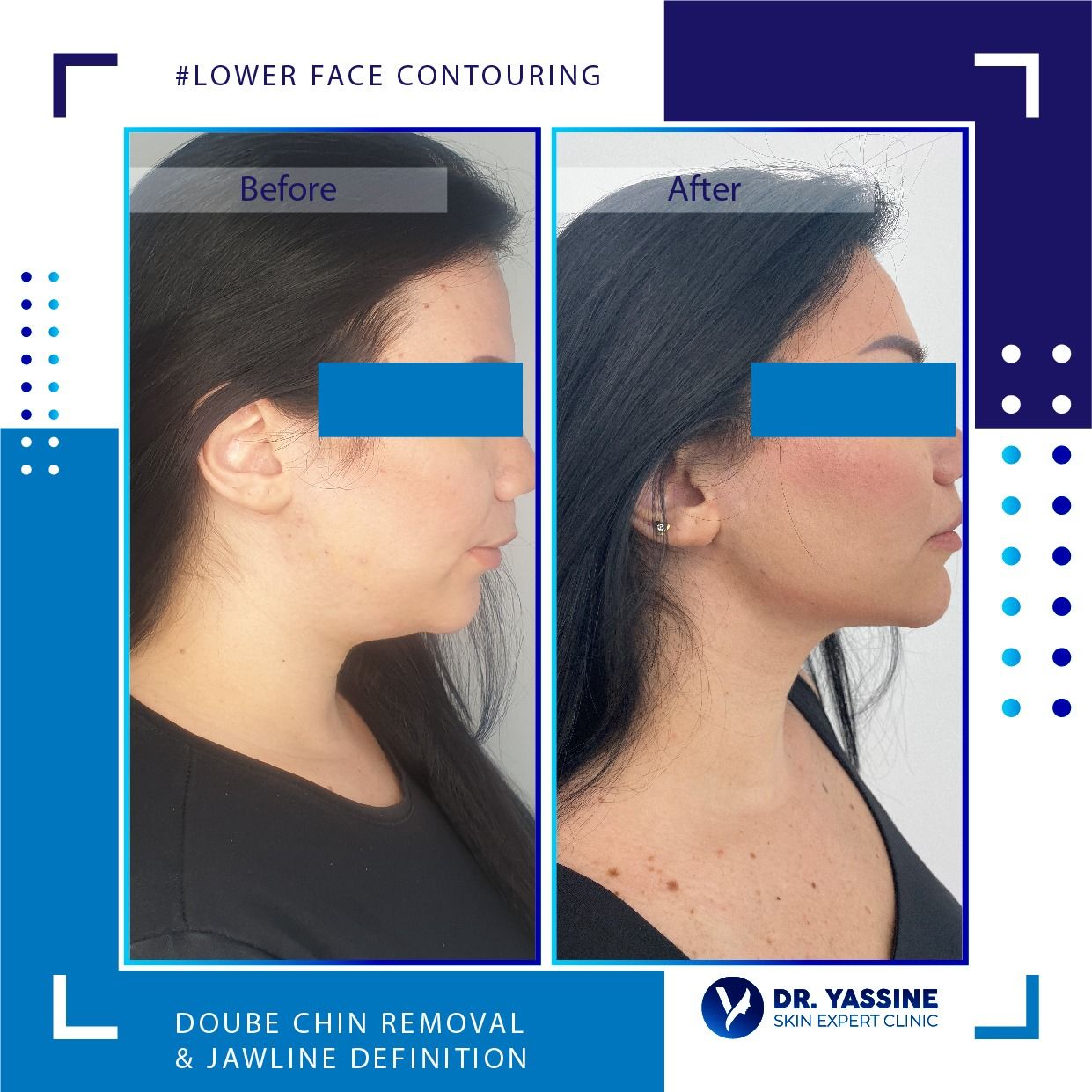 lower face contouring