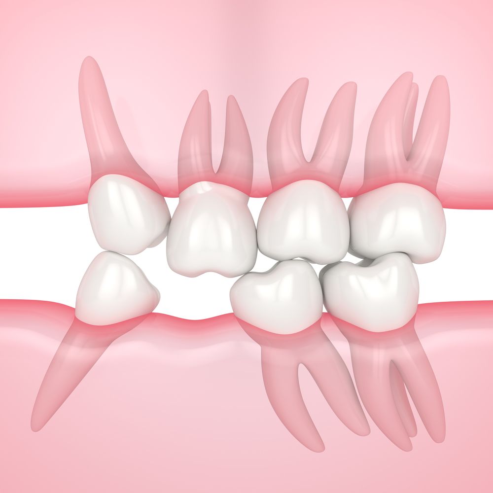 أسباب الفراغات بين الأسنان السفلي