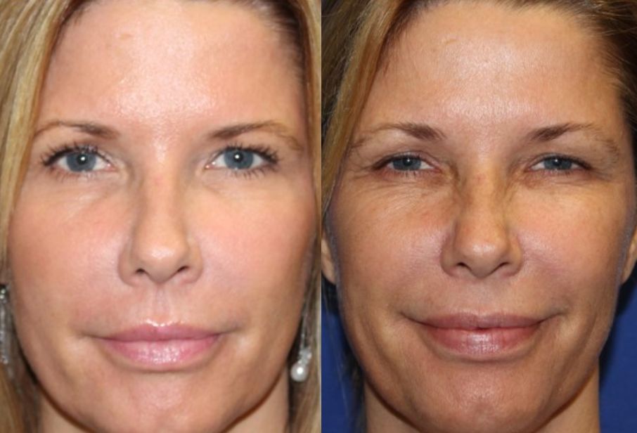 ⁨‎⁨تساعد الحجامة في الوجه في علاج المسامات الواسعة⁩⁩