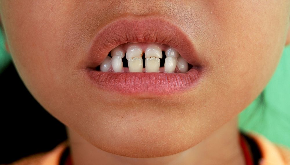 علاج الفراغات بين الأسنان السفلي