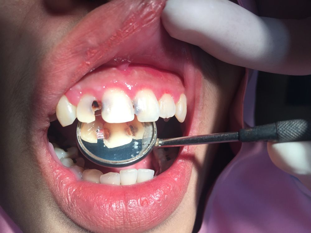 ما هي خطورة استراس الأسنان؟