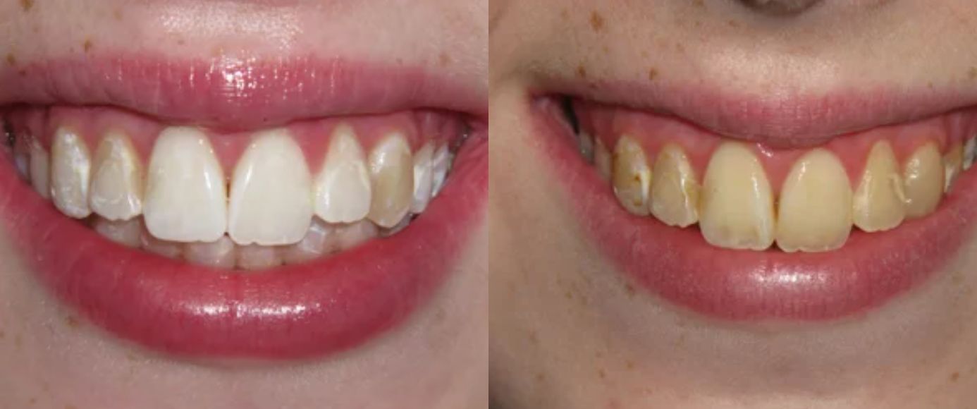 نتائج تقنية فلاش لتبييض الأسنان