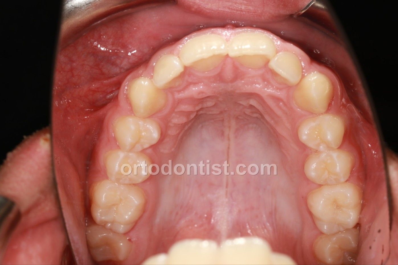 M.Emeklier Dijital Ortodonti Ortoaligner -image