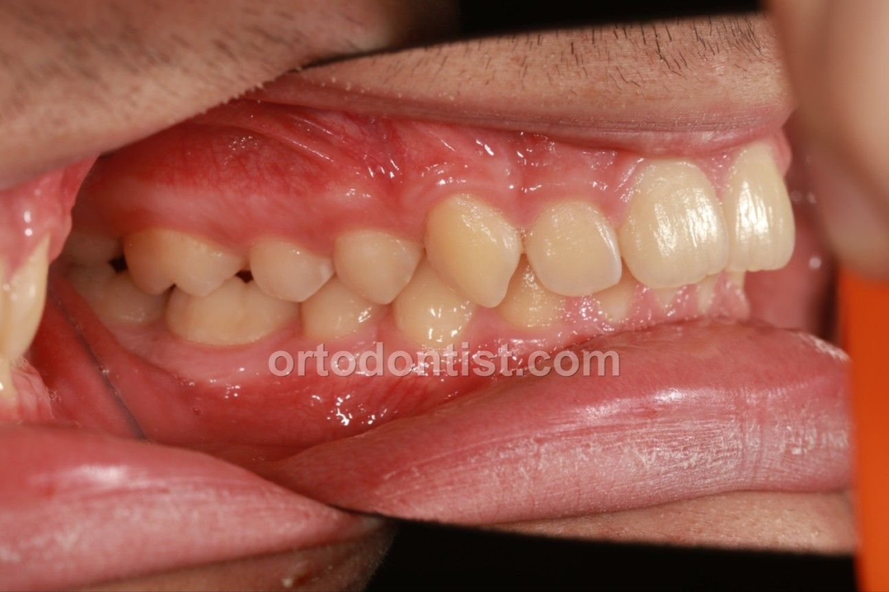 M.Emeklier Dijital Ortodonti Ortoaligner -image