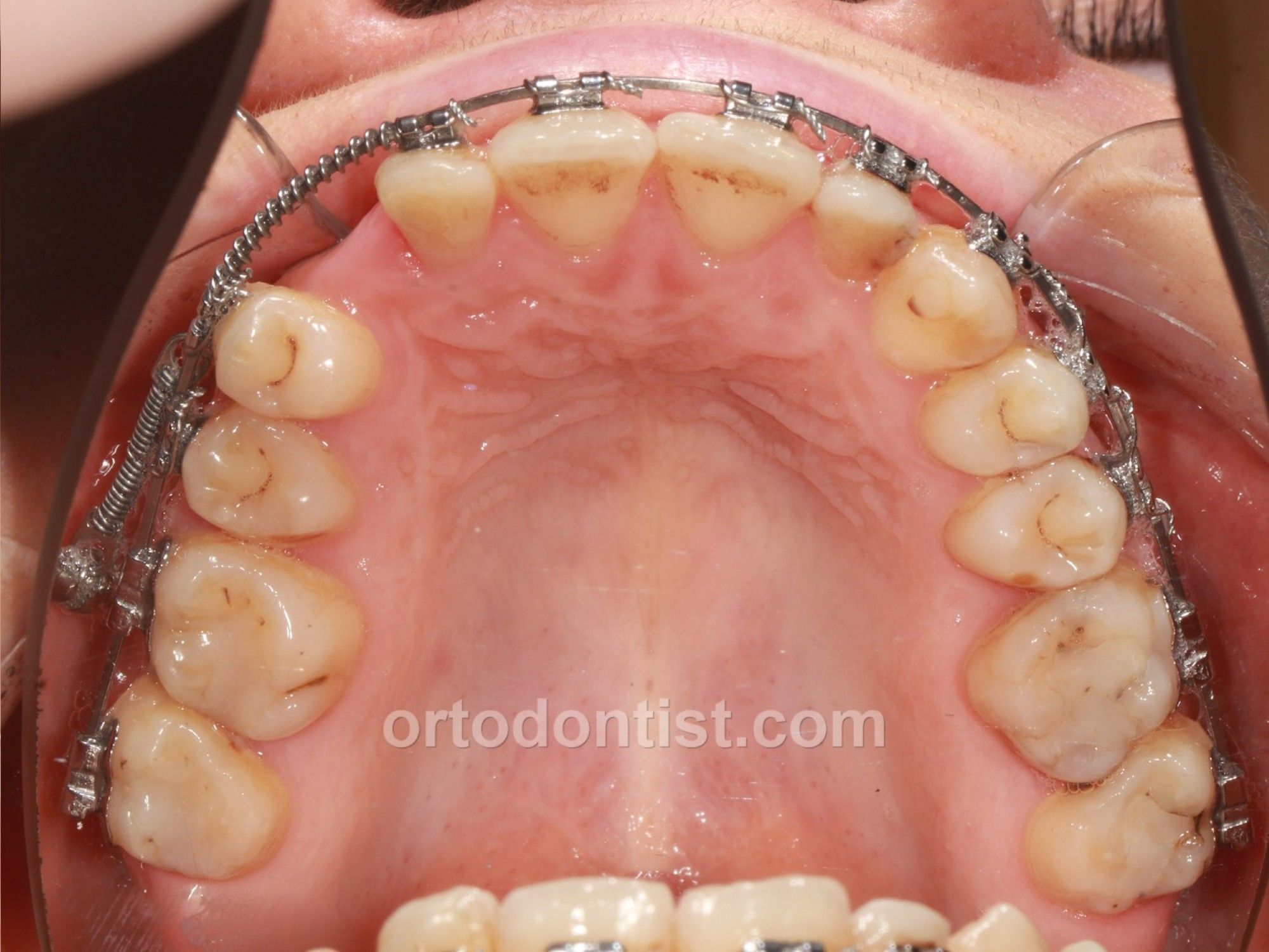 class 3 young patient orthognathic surgery 14