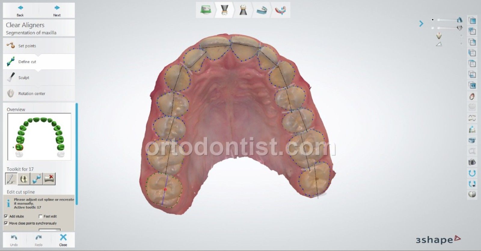 clear aligners young patient m.e 6
