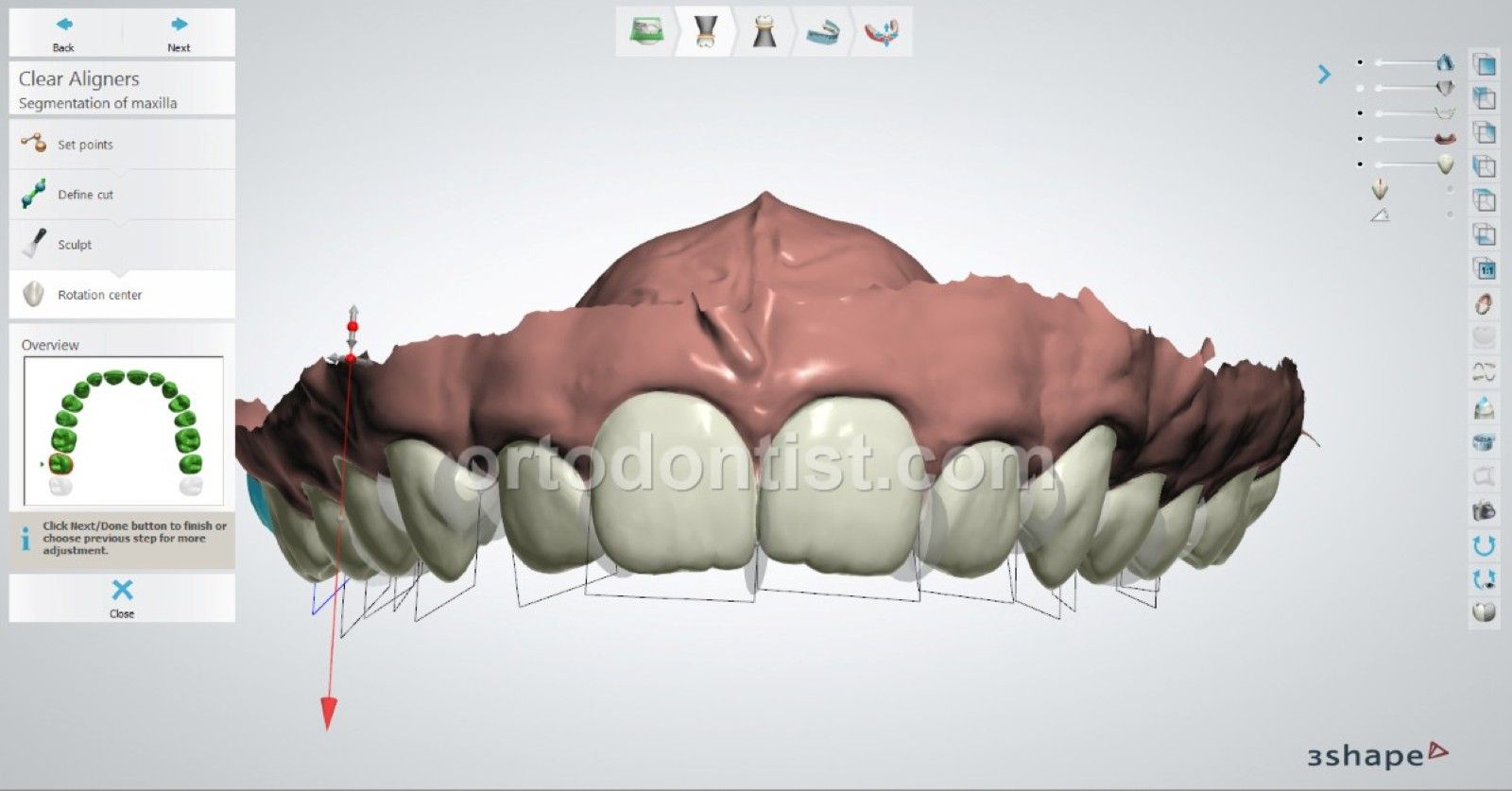 clear aligners young patient m.e 7