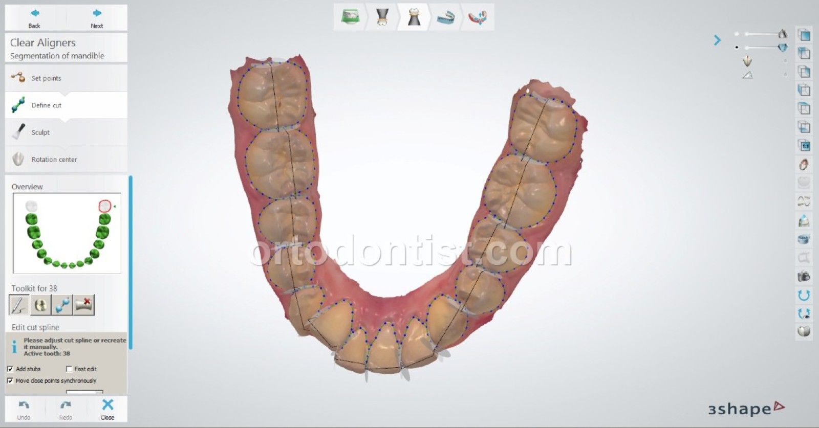 clear aligners young patient m.e 8
