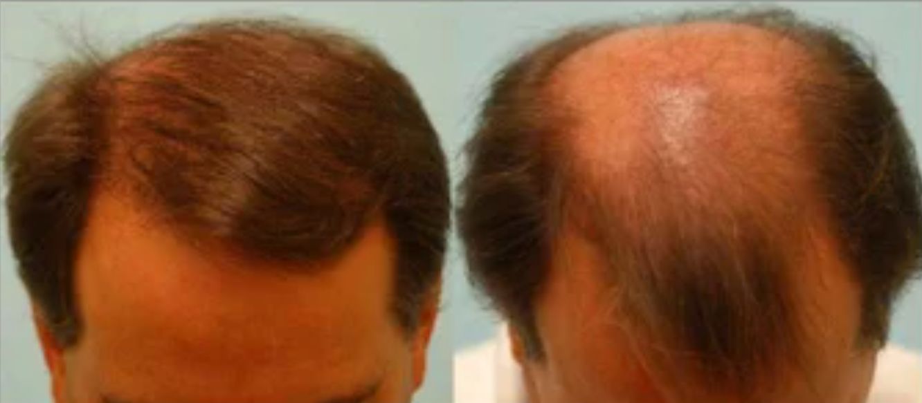 مميزات إجراء عملية زراعة الشعر بالمنصورة وعيوبها