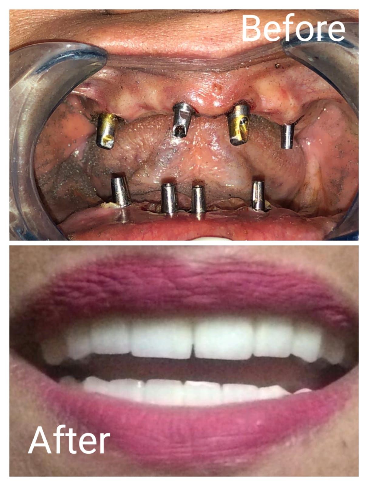 زراعة الأسنان قبل وبعد
