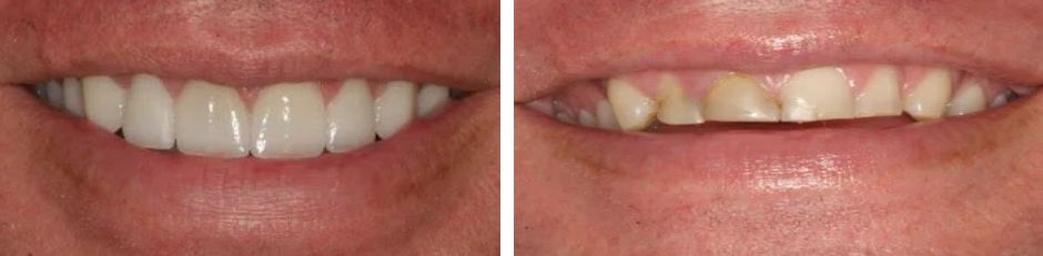 نتائج عملية ترميم الاسنان 