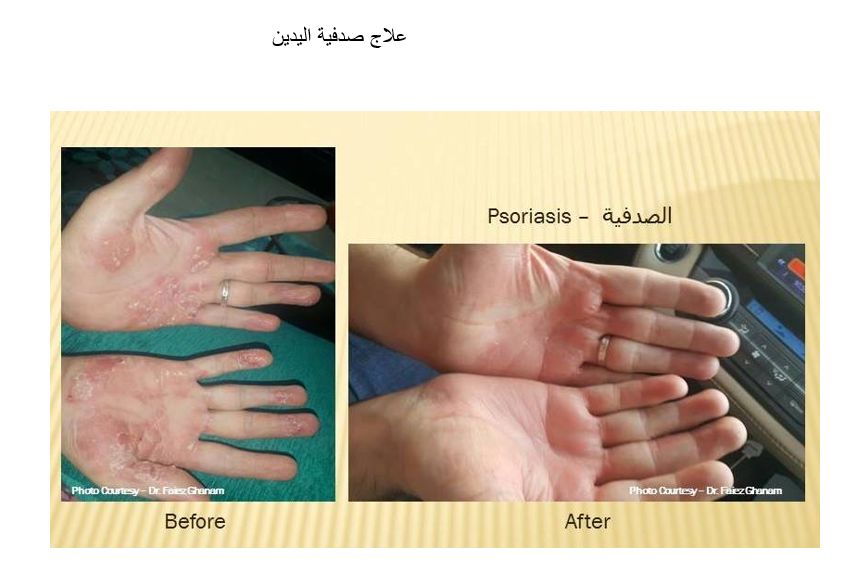 علاج صدفية اليدين